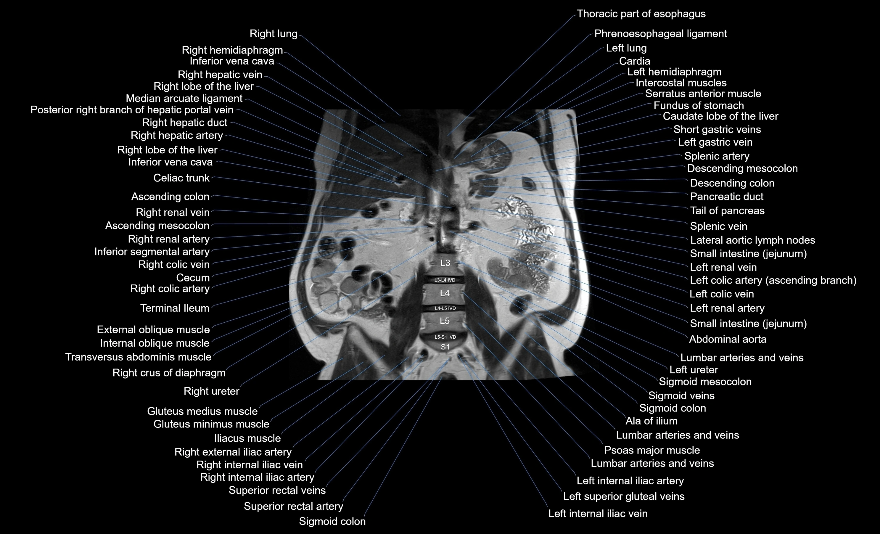 MRI Abdomen coronal labelled cross sectional anatomy radiology  image-img-00001-00033.webp